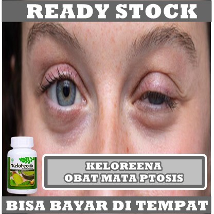 Obat Mata Beda Sebelah, Obat Mata Ptosis, Obat Kelopak Mata Turun Sebelah, Obat Sipit Sebelah, Obat Mata Kecil Sebelah, Obat Mata Besar Sebelah, Obat Mata Sipit Sebelah Bukan Dari Lahir Dengan Keloreena 100% Original