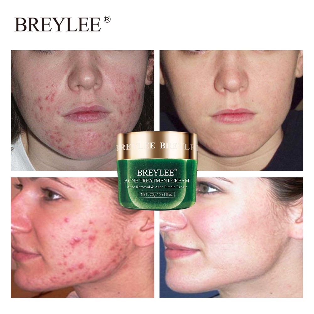 Breylee Acne Treatment Cream Anti Acne Pimple Removal Spots Oil Control Shrink Pores Moisturizing Shopee Indonesia