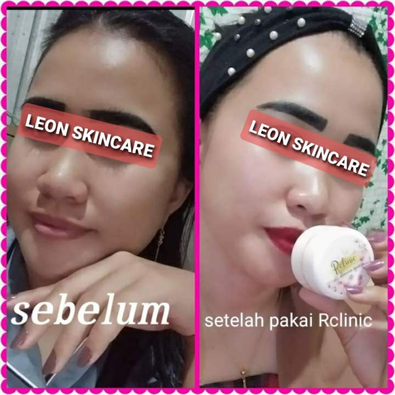 SALEP PELICIN WAJAH GLOWING (RCLINIC DOKTER)