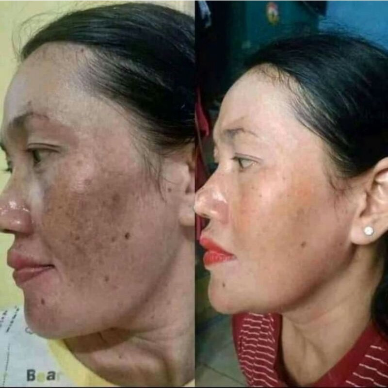 salep flek membandel