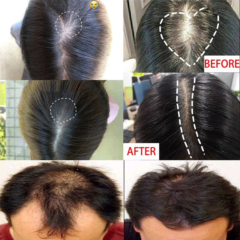 Shampo Penumbuh Rambut Cepat Serum Rambut Rontok Botak Rontok Penumbuh Rambut Perawatan Hair Care Treatment Anti Rambut Rontok-3