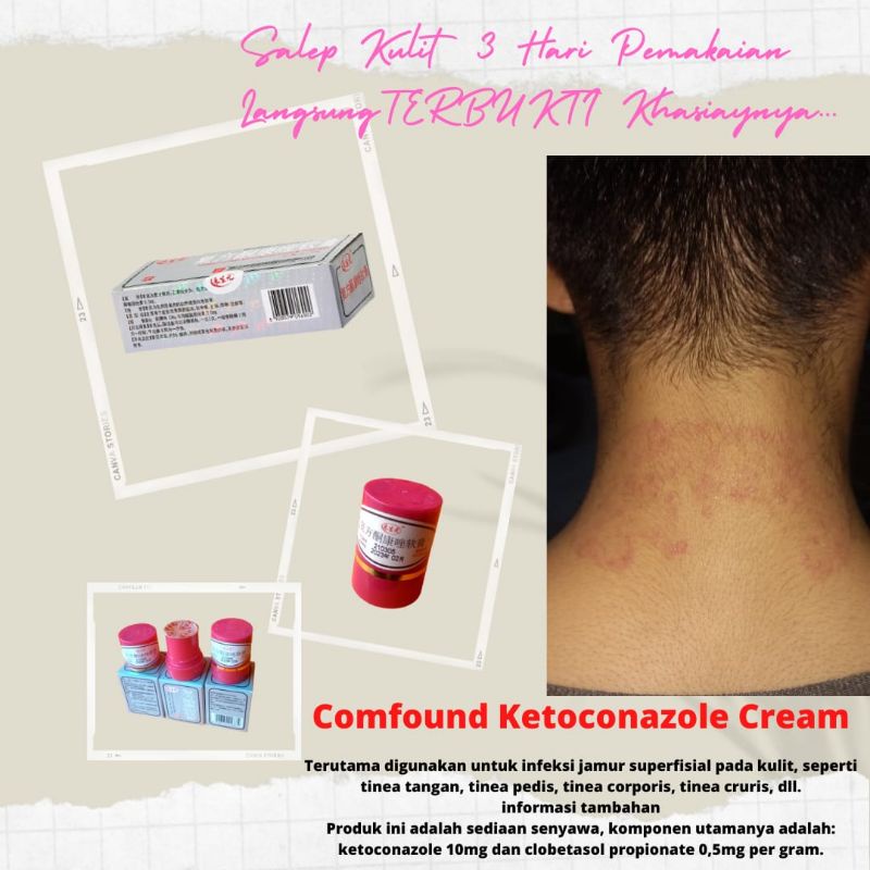 Salep Kulit Obat Gatal, Kulit Gatal,Selangkangan, Eksim, Jerawat, Jamur