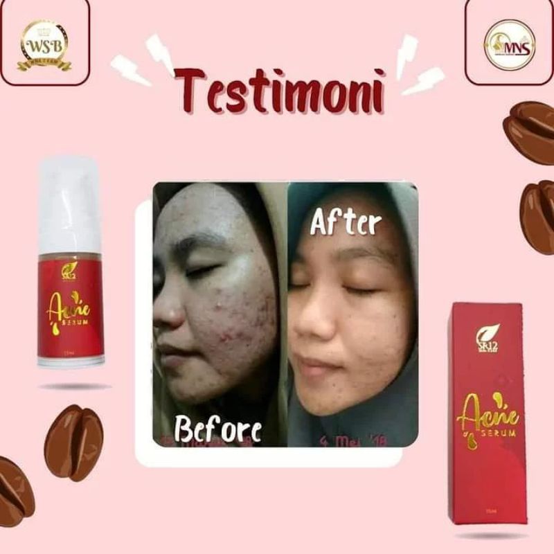 ACNE SERUM SR12 / MENYEMBUHKAN JERAWAT / BERUNTUSAN / MENGHILANGKAN BEKAS JERAWAT