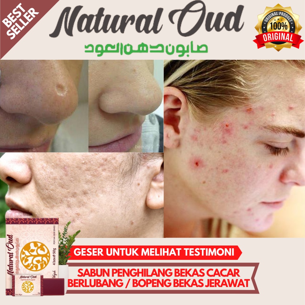 Jual Sabun penghilang Bekas cacar berlubang-Bopeng dan bekas jerawat