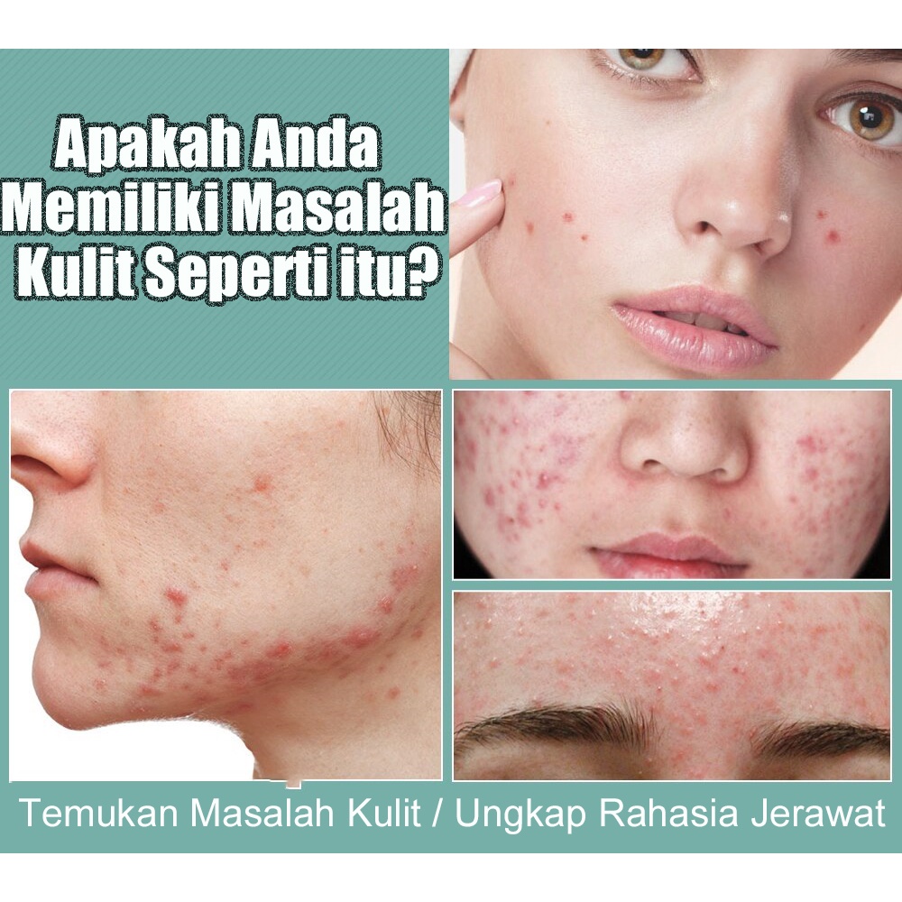 【Barang spot】Treatment Jerawat Perawatan Jerawat Ampuh Jerawat Gel Krim Jerawat Bruntusan Kulit Sensitif/Flek Hitam /Krim Jerawat Pria Wanita Cream Jerawat Ampuh Punggung /Wajah Pelembab Pemutih Perawatan Kulit Acne Gel Acne Serum Treatment Gel Moisturizi