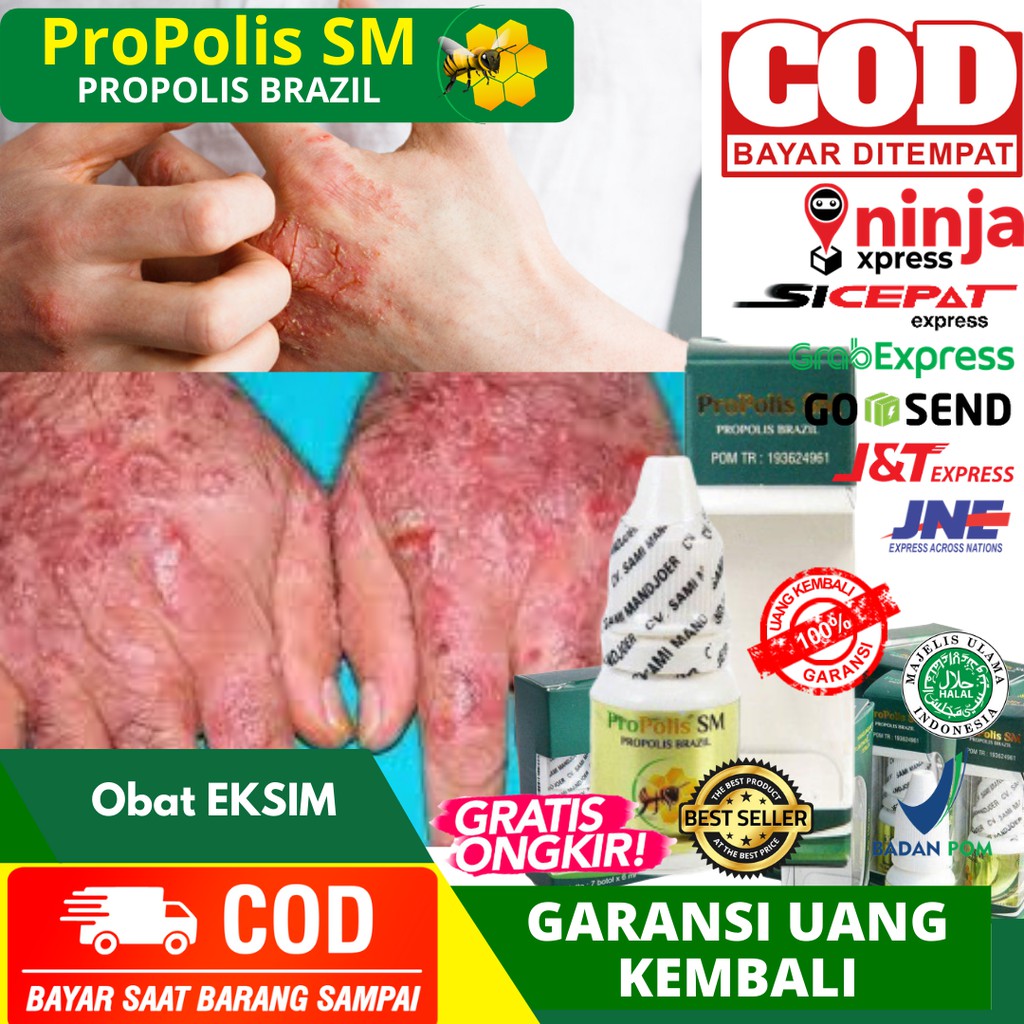 Obat Eksim, Eksim Basah, Eksim Kering, Obat Gatal Eksim, Salep Obat Oles Propolis SM Original