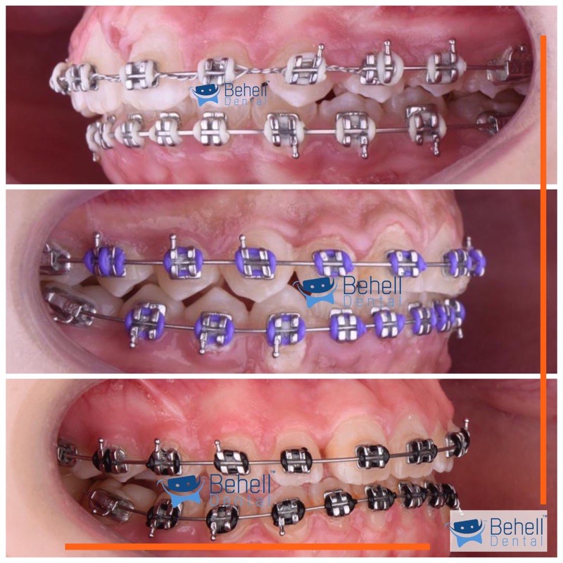 PAKET BEHEL PERMANEN METAL ORTHO BRACKET ORTHO CLASSIC USA ROTH WITH HOOK - Braces Dental OC OrthoClassic Untuk Perbaikan / Perawatan Gigi - Kawat Orthodontic Metalic - Behelldental