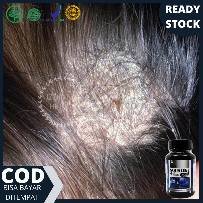 Bio Squalene - Obat oles tinea capitis / Kapitis pada anak & dewasa, Obat Tinea Capitis / Kapitis, O