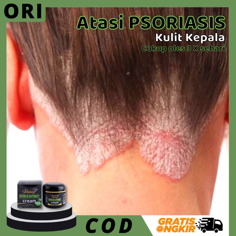 Obat Psoriasis Kulit Kepala Kering Gatal , Crem Binahong - Salep Psoriasis Kulit Paling Ampuh , Krim