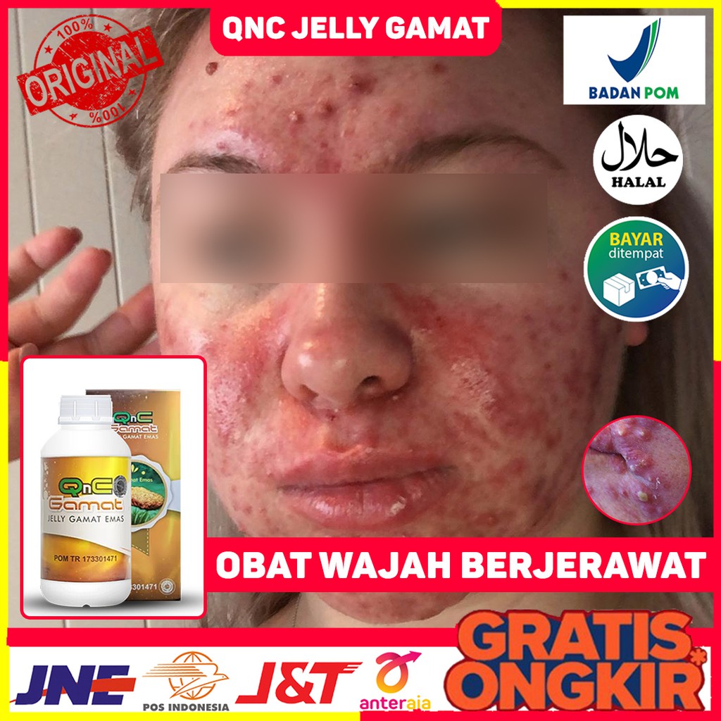 Obat Wajah Jerawat - Penghilang Jerawat -  Jerawat Batu - Jerawat Menahun - Jerawat Bruntusan - Jera