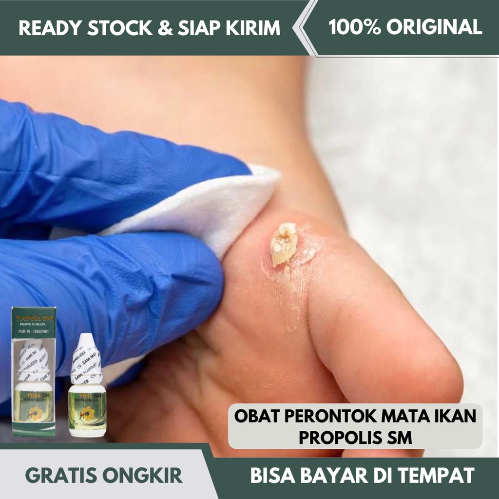 Obat Tetes Perontok Mata Ikan di Telapak Kaki, Obat Kapalan Di Kaki, Mata Ikan di Kaki, Obat Mata Ik