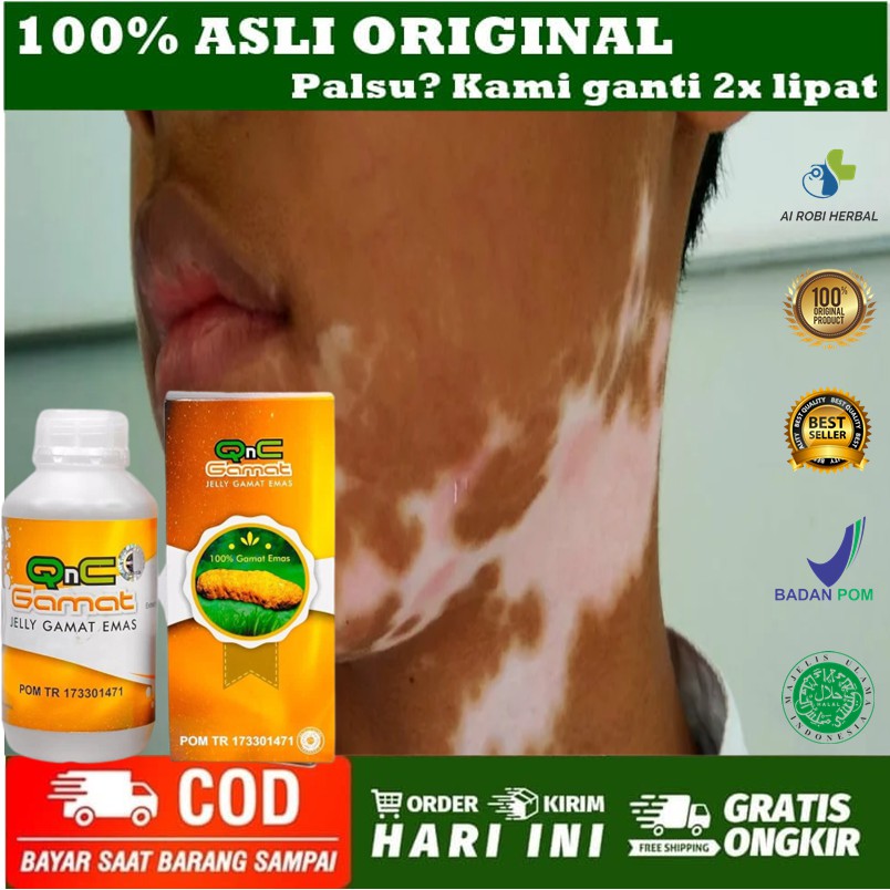 Obat Vitiligo - Obat Kulit Vitiligo - Obat belang Putih Di Kulit - Obat Kulit bercak Putih Aman BPOM