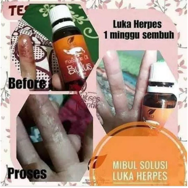 

Minyak Bulus Sr12 herbal skincare