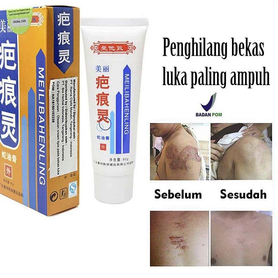 Pasti Ready O Original Bpom Penghilang Bekas Luka Cream Meilibahenling Penghilang Luka Keloid Shopee Indonesia