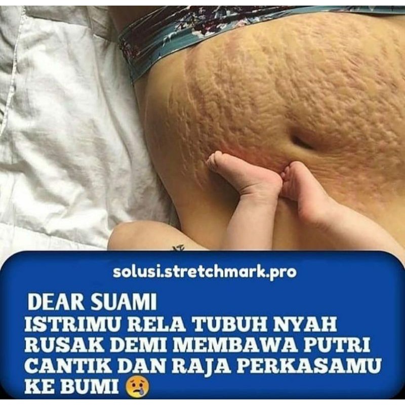 Garansi Original | Serum Strectmark Penghilang Strectmark Ampuh Strectmark Cream Oxter Gel Vitaline 