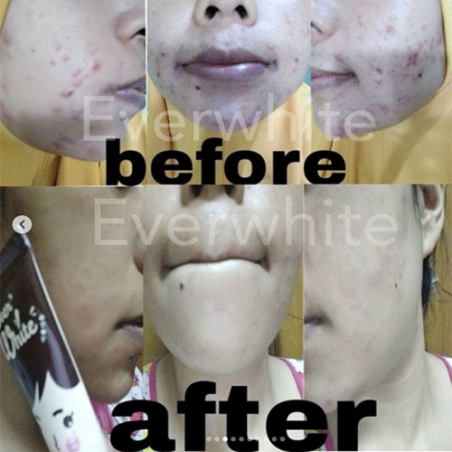 EVERWHITE Acne Pair Cream| Acnepair Cream | Toner | Cleanser | Acnepair Series