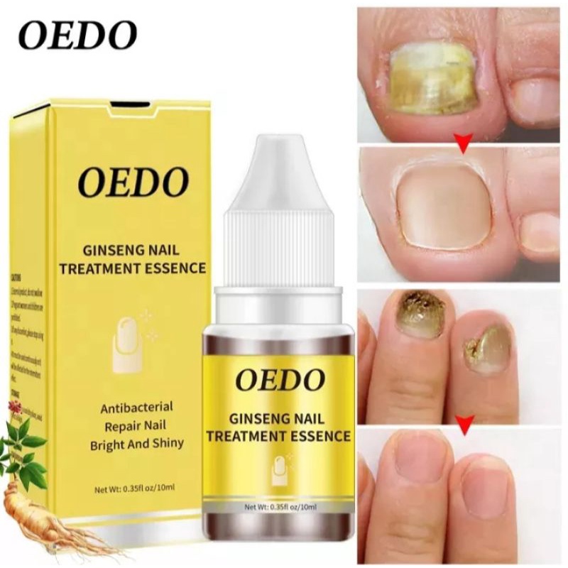 OEDO TREATMENT KUKU ANTI BAKTERI, PERBAIKAN KUKU