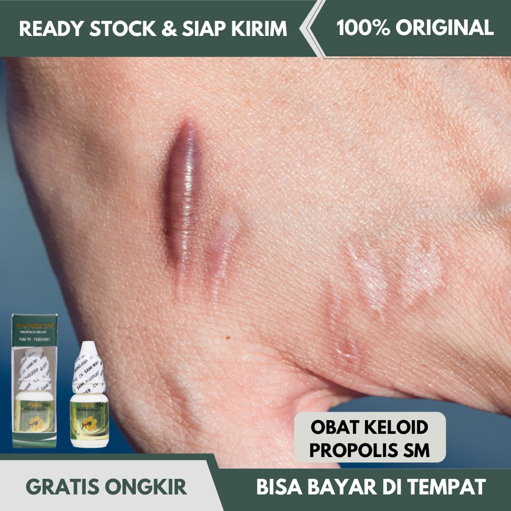 Obat Keloid Asli, Obat Keloid Ori, Obat Keloid Oles, Obat Keloid Gatal, Obat Keloid Bukan Cina, Obat