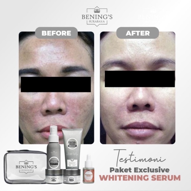 BENING'S PAKET EXCLUSIVE | MENGATASI FLEK, MELASMA &amp; MENCERAHKAN KULIT