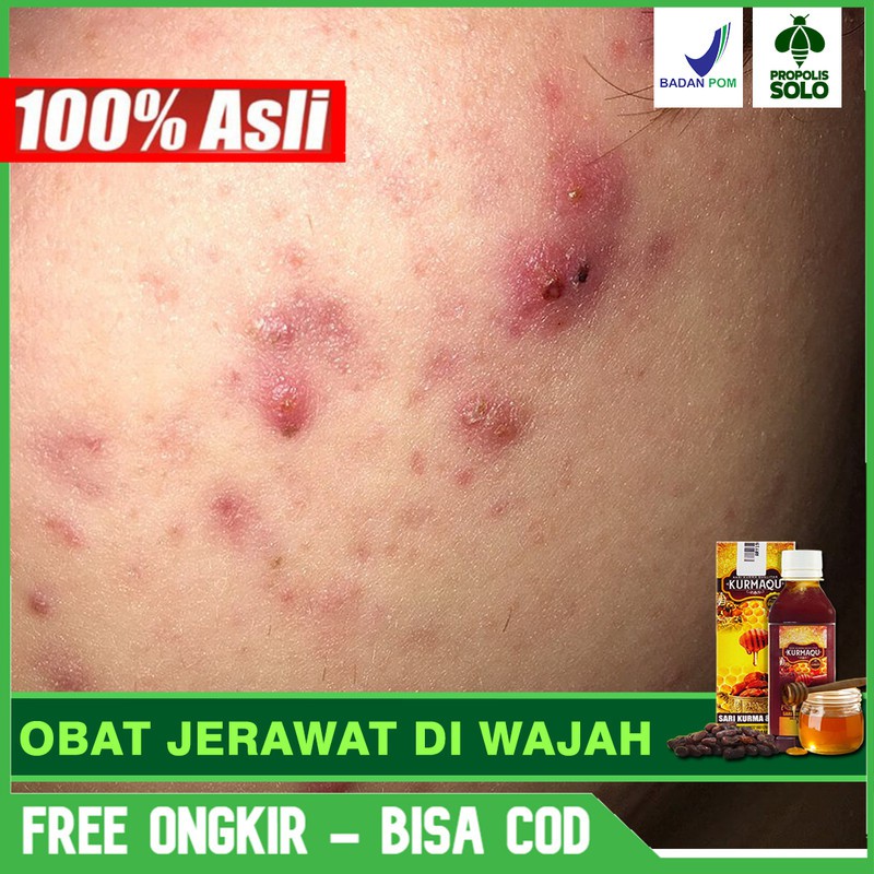 Obat Jerawat Di Wajah, Acnes, Beruntusan Alami Terlaris Madu & Sari Kurma Di SOLO Bisa COD