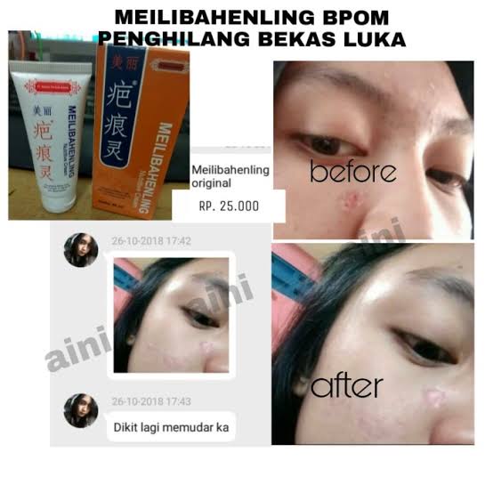 MEILIBAHENLING NUTRITIVE CREAM OBAT PENGHILANG BEKAS LUKA CREAM SALEP OBAT PEMUTIH KULIT TUBUH ORIGINAL | SCAR CREAM BEKAS CACAR JAITAN PENGHILANG LUKA BAKAR KNALPOT LUKA AIR PANAS