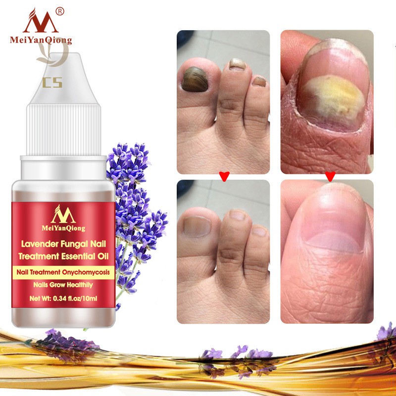 Cs 10ml Nail Fungus Treatment Anti Fungal Toenail Repair Care Lavender Essential Oil Shopee Indonesia