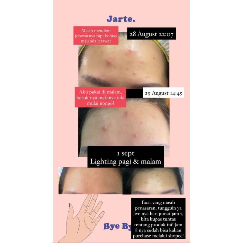 (GOSEND/COD) Jarte Bye Bye Acne - Spot Tretment Lotion 30ml (FULL Size)