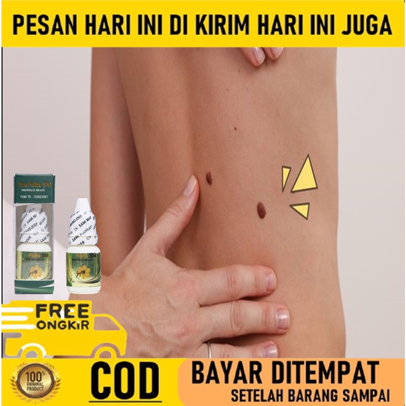 Obat Papiloma - Obat Papiloma leher - Penghilang kutil leher - Obat Kutil di leher - Obat Penghilang