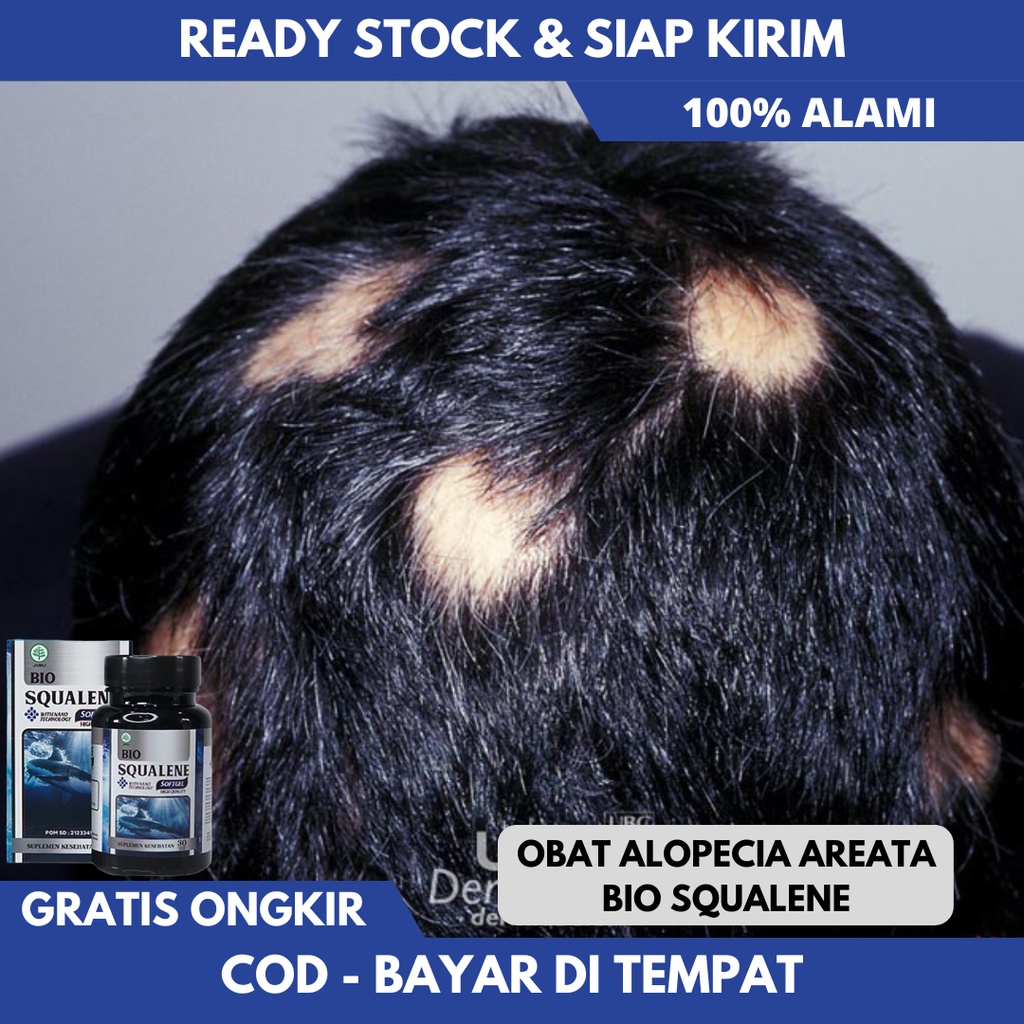 Jual Obat Alopecia Areata, Penumbuh Rambut Botak, Kebotakan Rambut Pada