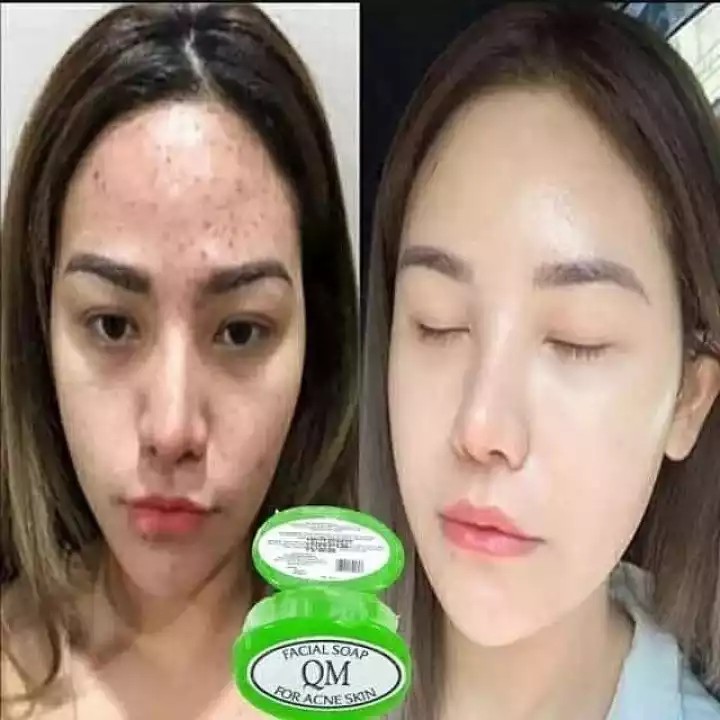 [ORI] QM SABUN ACNE HIJAU | Facial Soap Anti Acne Mengobati dan Mencegah Jerawat Membandel di Wajah