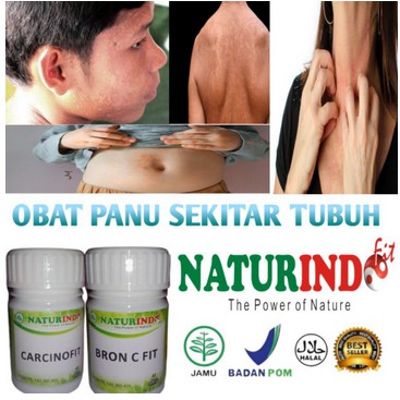 Obat Penghilang Panu Membandel Obat Kurap obat Kudis Obat Penyakit Kulit Obat Panu Paling Ampuh