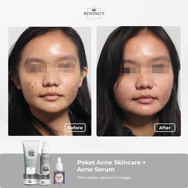 Skinmology Paket 5in1 Acne Expert Series Berjerawat | Bening Skincare | Skinmology Benings