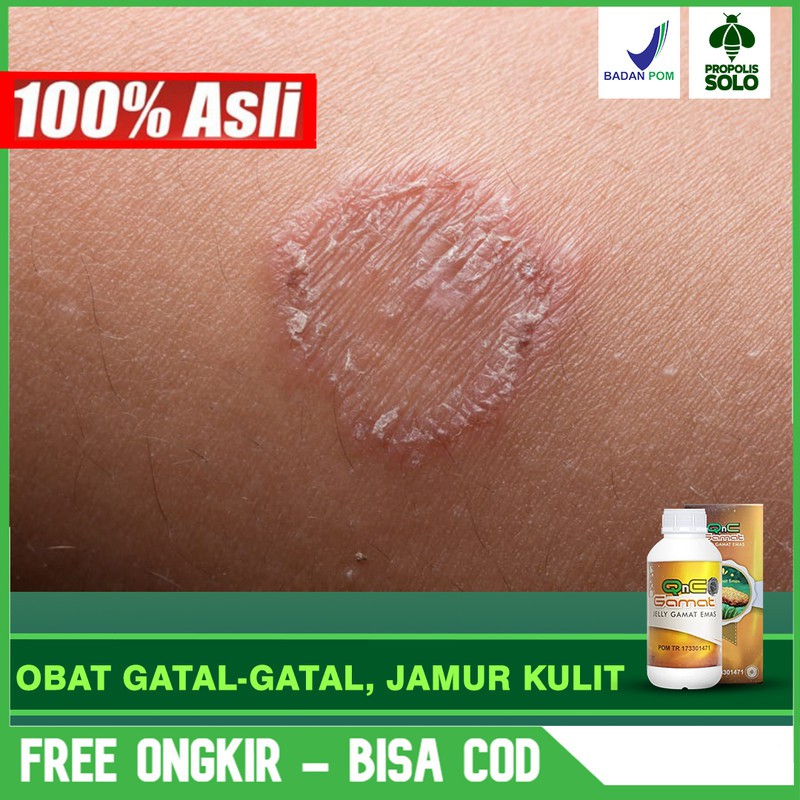 

Obat Infeksi Paru, Pneumonia, Paru Paru Basah 100% Alami QNC Jelly Gamat Herbal Terlaris Bisa COD