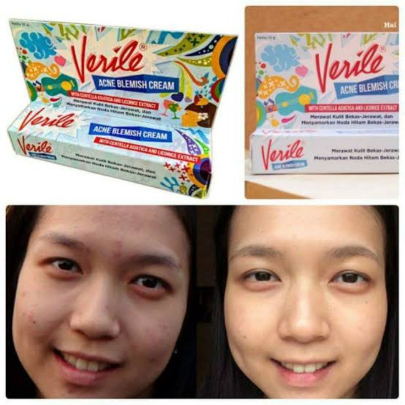 Verile Acne Blemish Cream/ Verile Acne Gel/ veril original