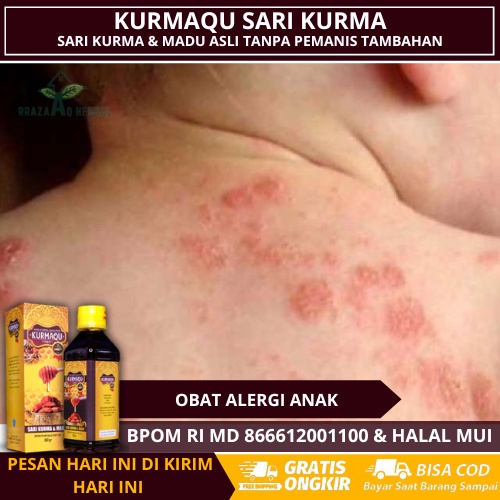 Obat Alergi Anak, Alergi Kulit Pada Anak, Kulit Kemerahan Pada Anak, Menghilangkan Gatal Gatal Di Ku