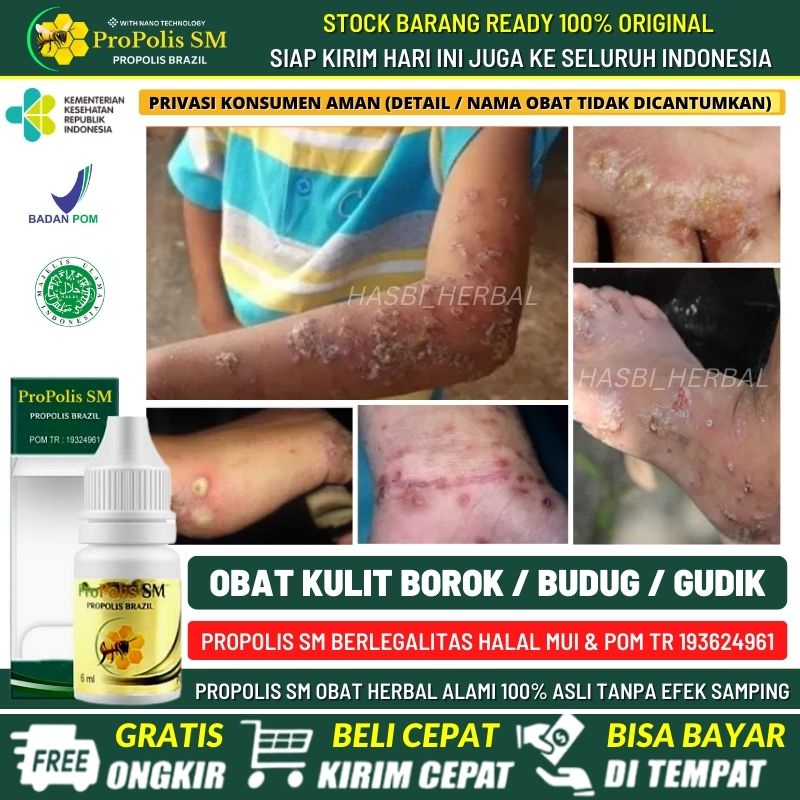 Obat Borok, Salep Borok Bernanah, Borok Berdarah, Bentol - Bentol Berisi Nanah Disertai Gatal Parah,