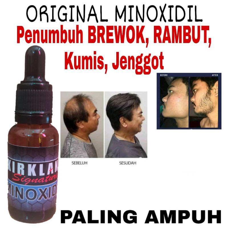 Minoxidil penumbuh brewok rambut kumis jenggot