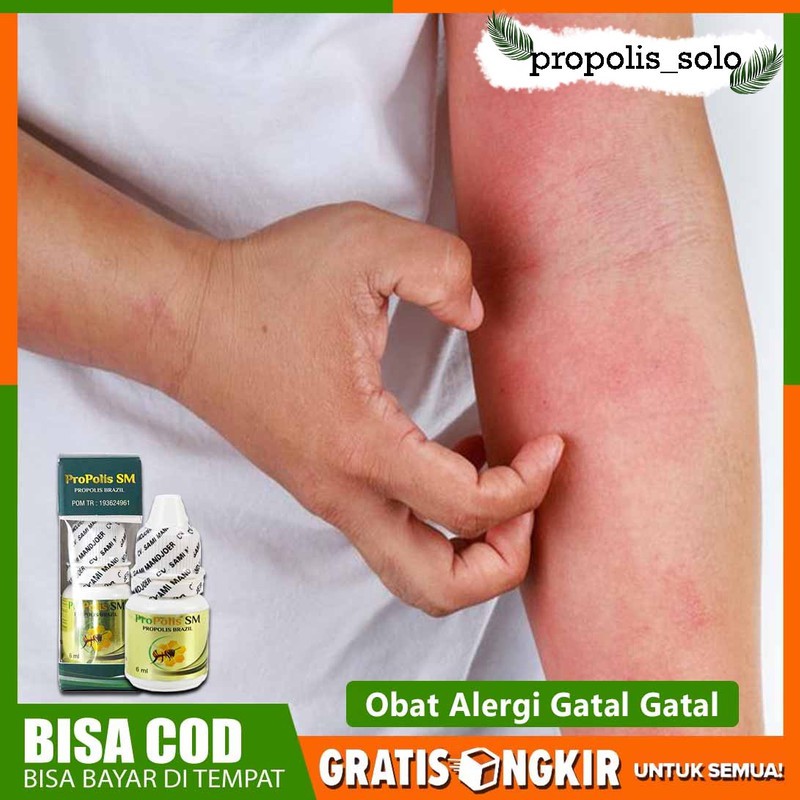 Obat Alergi Gatal Ruam - Alergi Gatal Pada Kulit Anak - Obat Alergi Gatal2 - Propolis Sm