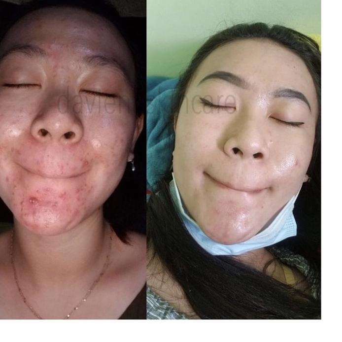 [LR3]DAVIENA SKINCARE ACNE SERIES-HOT SALE