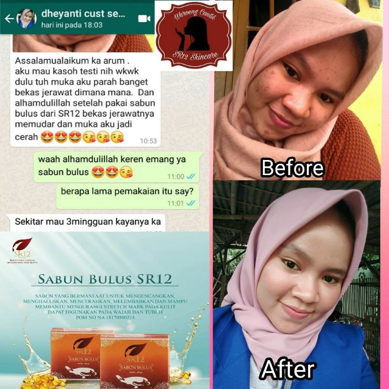 Sabun Bulus SR12 - Sabun Muka Glowing - Sabun Jerawat Badan dan Punggung Aman BPOM