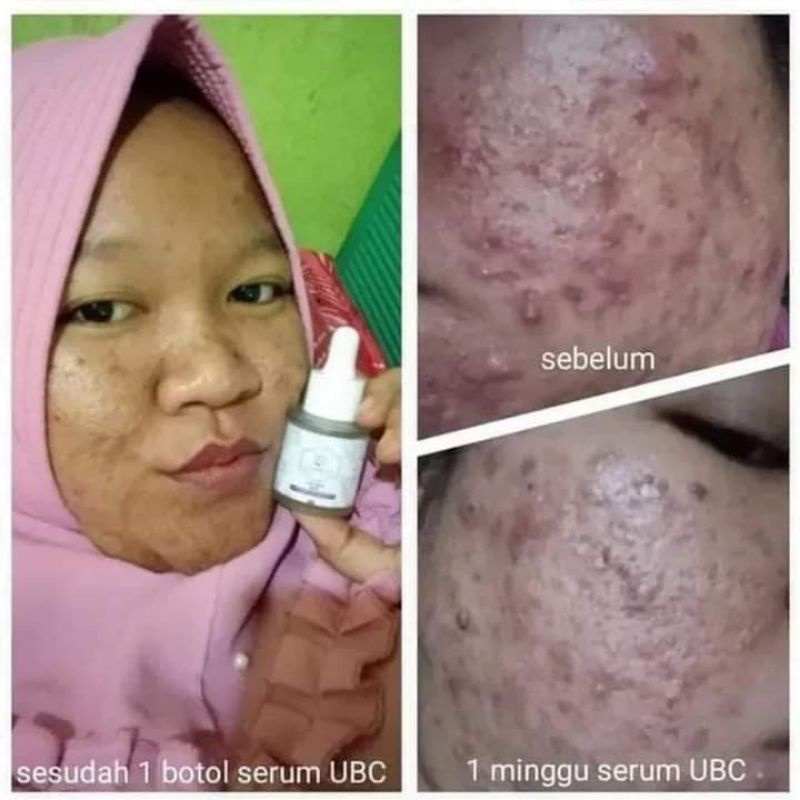 Acne spot serum by umi alfatih (Umi beauty