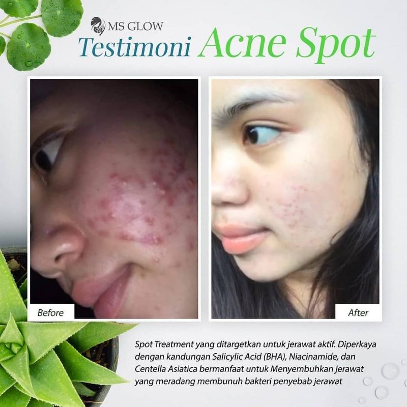 PROMO SPOT TREATMENT MSGLOW DARK SPOT PORE AWAY ACNE SPOT