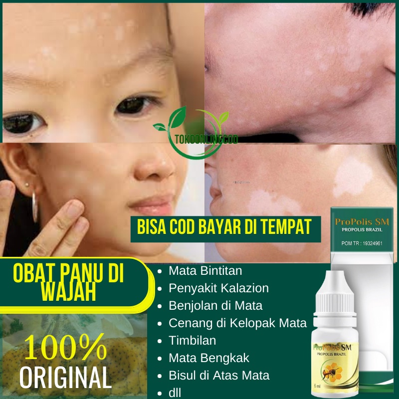 Obat Bercak Putih di Wajah - Panu di Punggung - Hapur ditubuh - Jamur Kulit Selangkangan - Kurap Kep