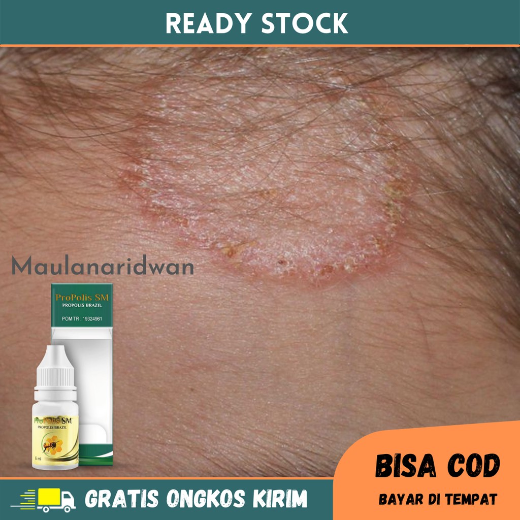 Obat Kurap, Kurap Di Selangkangan, Kudis, Obat Herbal Kurap Menahun Propolis SM