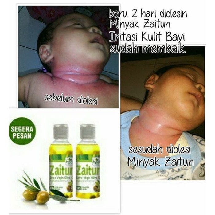 Yuk Simak Manfaat Minyak Zaitun Untuk Wajah Anak 