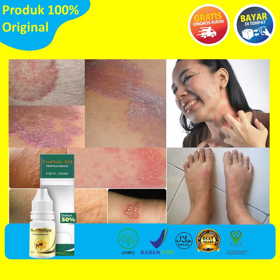 Propolis SM Untuk Gatal 100% Asli Aman Untuk Anak Dan Dewasa Tanpa Efek Samping - Riswan Herbal