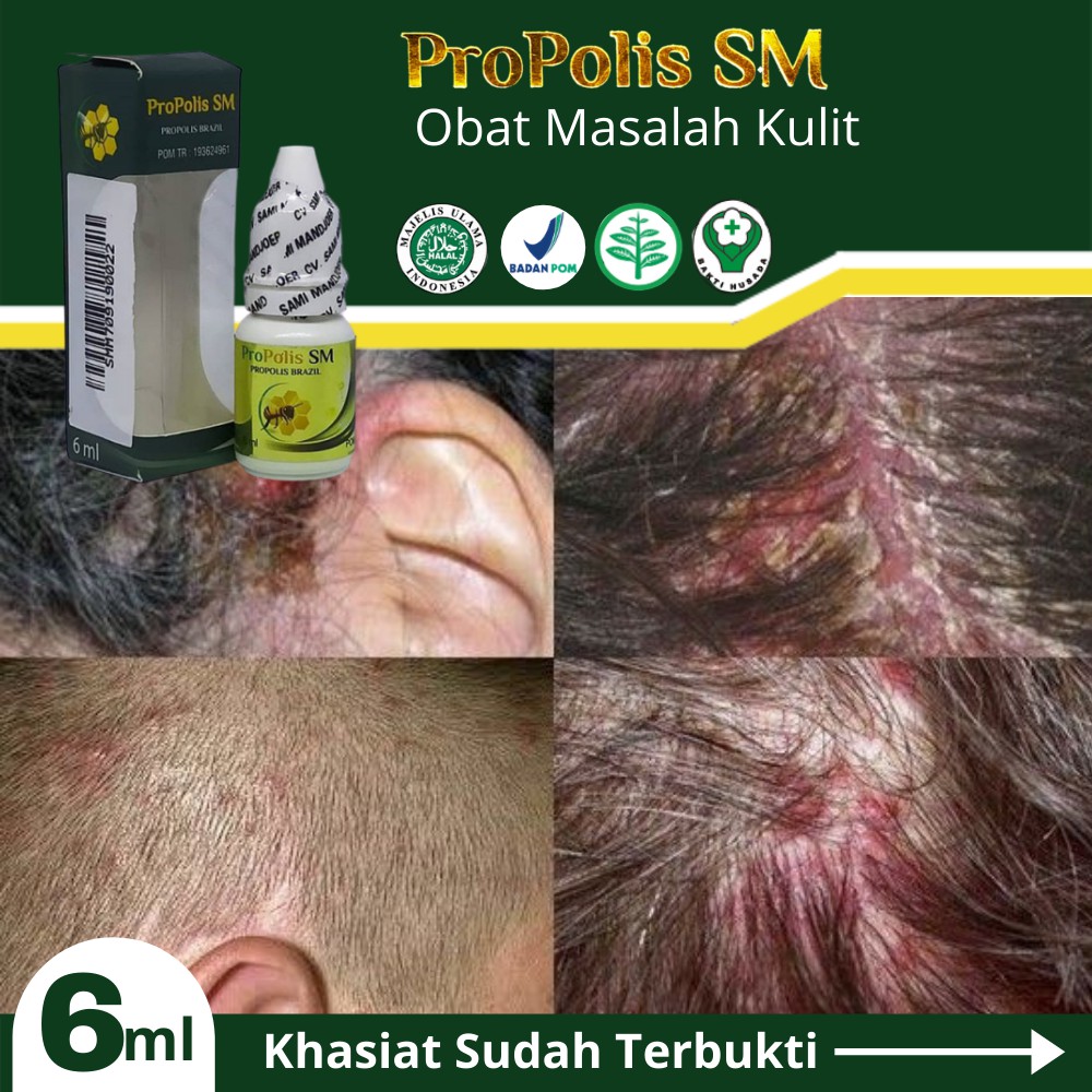 Herbal Borok Parah Di Kepala Koreng Obat Luka Bernanah Propolis Sm Brazilian Bpom Cod Shopee Indonesia