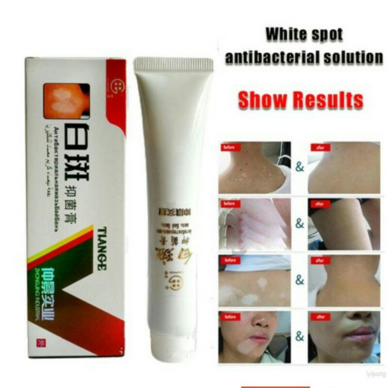 Original Salep Vitiligo Bercak Putih Bahan Herbal