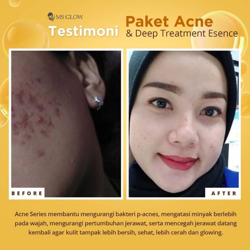 MS GLOW PAKET ULTIMATE UNTUK MENGHILANGKAN FLEK HITAM