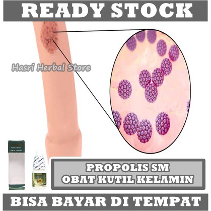 OBAT KUTIL KELAMIN HPV PAPILOMA JENGGER AYAM ANPILOMA PERONTOK KUTIL PAPILOMA KONDILOMA JENGGER AYAM TA HI LALAT MATA IKAN PRIA WANITA HERBAL PROPOLIS SM BRAZIL